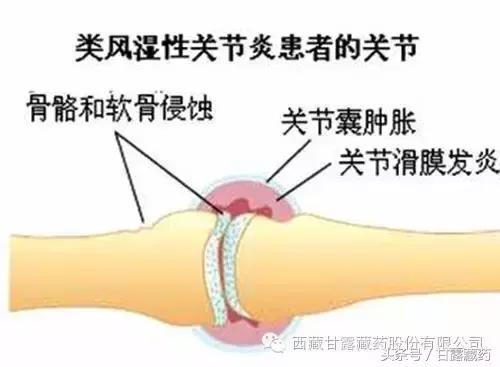 免疫力正常类风湿病能根治吗,日本类风湿性关节炎能根治吗