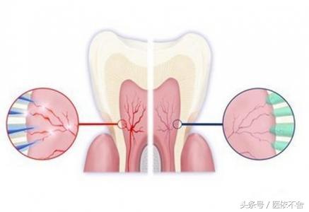 遇到冷热酸甜牙齿敏感,牙齿遇冷热都敏感怎么治疗