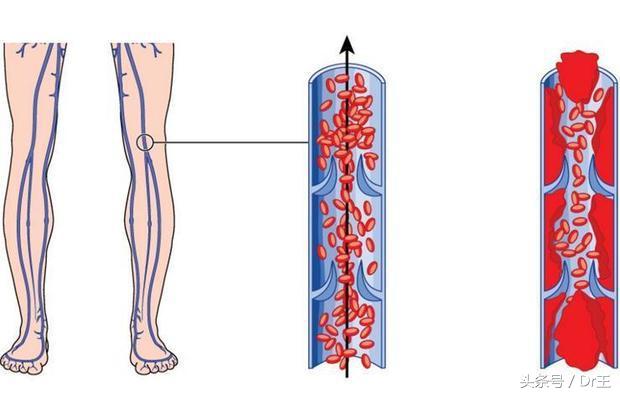 突然咳血块一般什么原因导致,突然咳嗽有黑血怎么回事