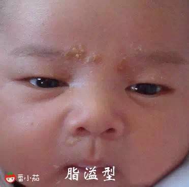 宝宝湿疹可以用激素药么,宝宝湿疹可以拿金银花水擦吗