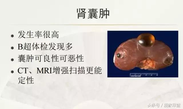 布什还是奥巴马?放射科杨大夫谈体检查出的结节和囊肿