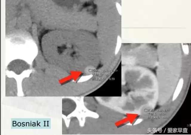 布什还是奥巴马?放射科杨大夫谈体检查出的结节和囊肿