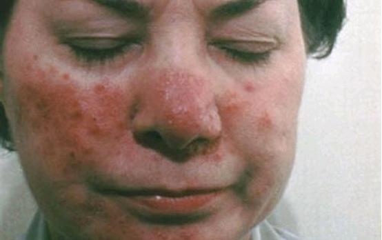 皮肤泛红有小疹子是怎么回事,皮肤泛红痒有小疙瘩