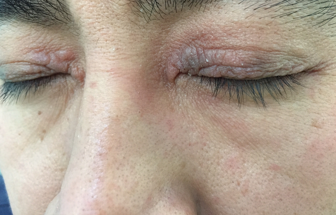 眼睑部位神经性皮炎能根治吗,脖子后面神经性皮炎怎么根治