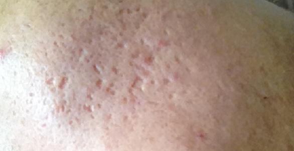 真正祛痘印最好的方法,最简单有效祛痘印的方法