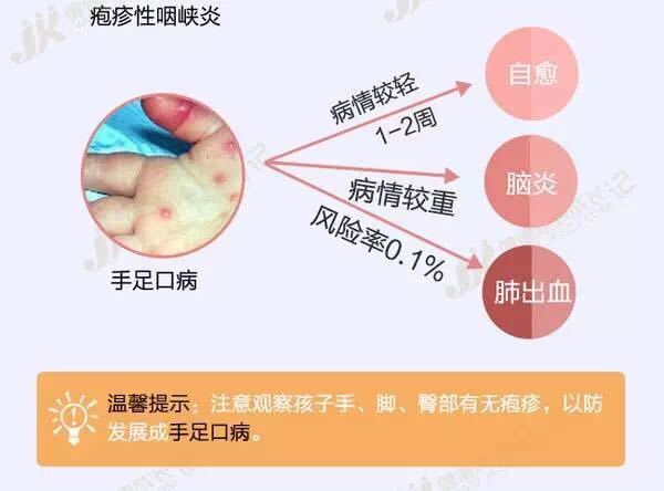 疱疹性咽峡炎可以吃什么药预防,小儿疱疹性咽峡炎的治疗