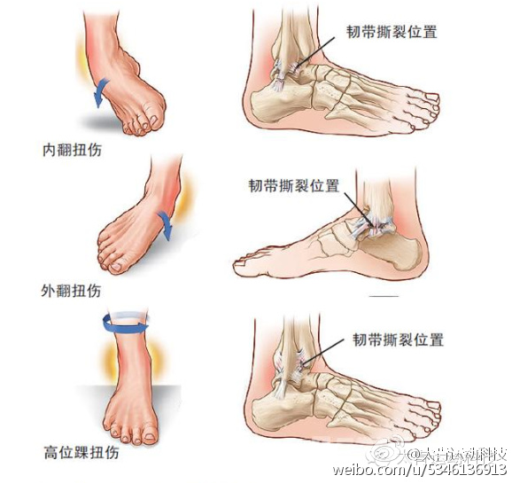 如何在打篮球中避免伤病,打篮球的人脚常见伤病