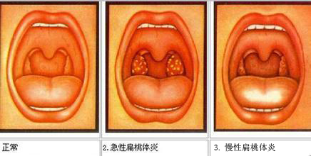 宝贝睡觉打呼噜宝妈要注意了,推拿小儿打呼噜