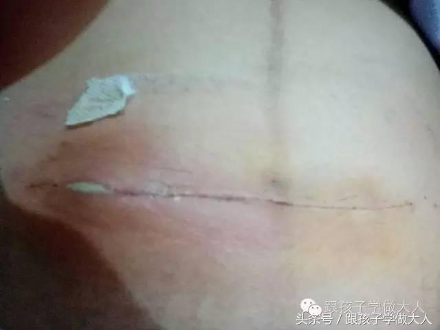 剖腹产8大禁忌,剖腹产后注意事项及禁忌