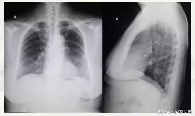 布什还是奥巴马?放射科杨大夫谈体检查出的结节和囊肿