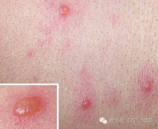 如何用魏氏八卦挑针治疗带状疱疹?