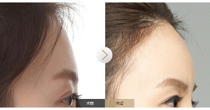 自体脂肪丰额头效果怎样,自体脂肪丰额头效果明显吗