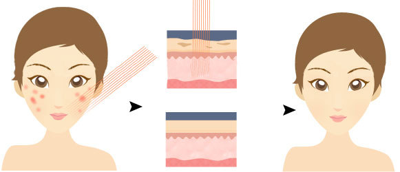 斑斑怎么护肤,解救双面斑斑