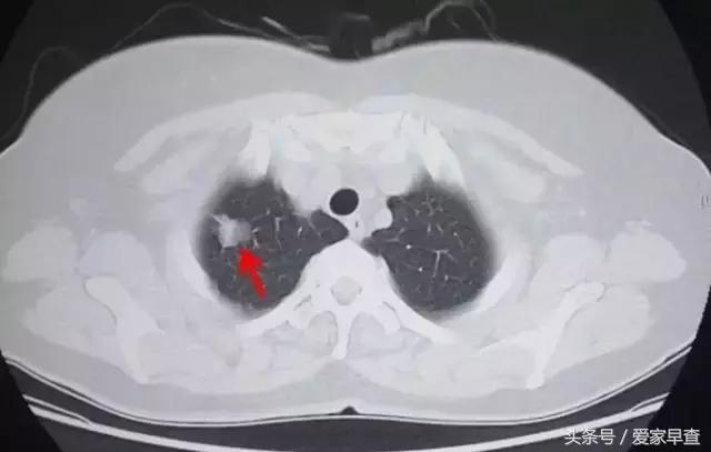 布什还是奥巴马?放射科杨大夫谈体检查出的结节和囊肿