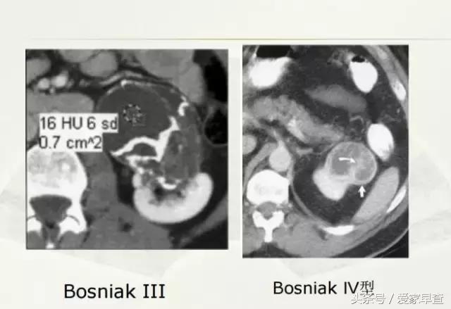 布什还是奥巴马?放射科杨大夫谈体检查出的结节和囊肿