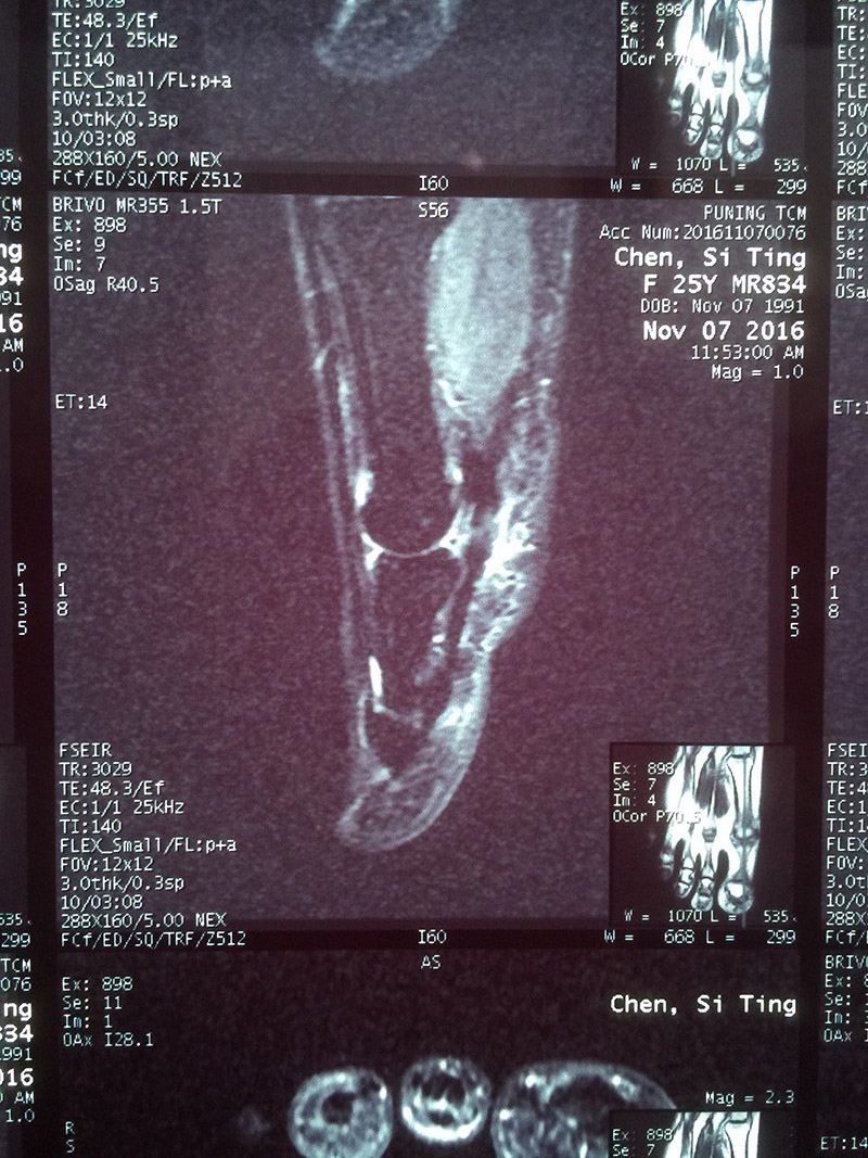 脚趾屈指肌腱的损伤,脚趾疼痛预示身体病变