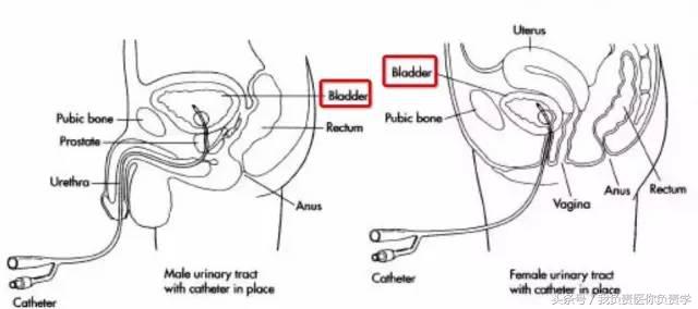 干货:留置尿管到底几天更换一次?见尿为何要再插入?
