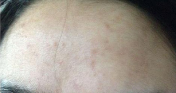 真正祛痘印最好的方法,最简单有效祛痘印的方法