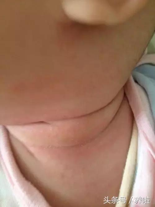 宝宝脖子淹了破皮红了怎么办,新生儿脖子淹了破皮用氧化锌软膏