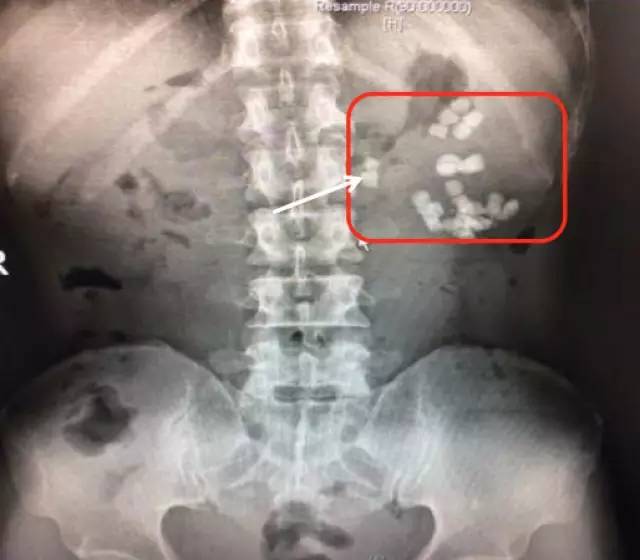 肾结石治疗最佳方案钬激光碎石,治疗肾结石案例