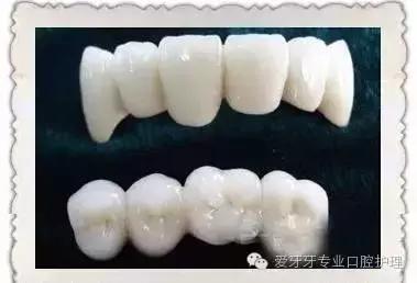 不同价格的牙冠区别在哪里,不同价格的烤瓷有区别吗