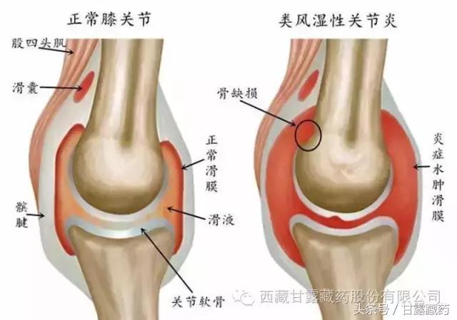 免疫力正常类风湿病能根治吗,日本类风湿性关节炎能根治吗