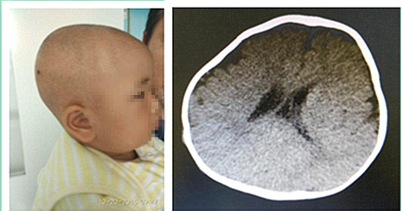 颅骨凹陷性骨折复位视频,儿童鼻骨骨折做手术是微创手术吗