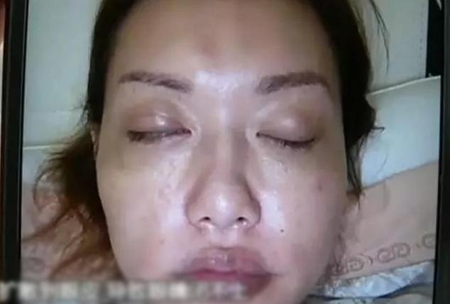 女子打瘦脸针后嘴歪了,杭州女子打完瘦脸针口外眼斜
