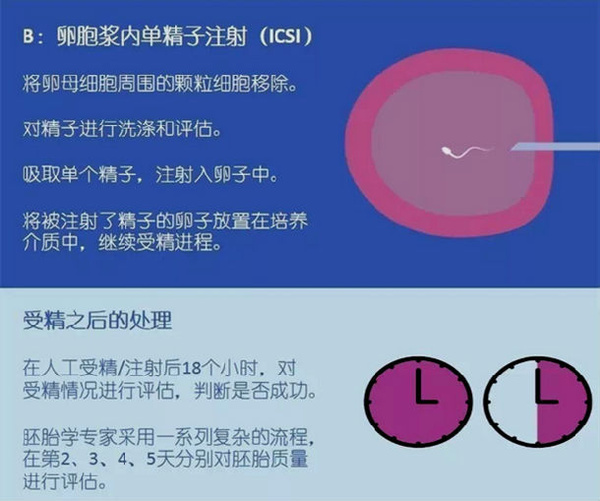 试管婴儿的正确方法及其流程,试管婴儿五种方法