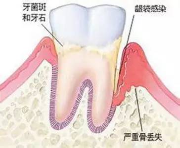 牙结石会导致牙齿脱落吗,牙结石自己脱落土偏方
