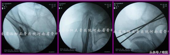 经皮置入术在骨盆髋臼骨折治疗中的应用骨医小灶第二十一期(中)