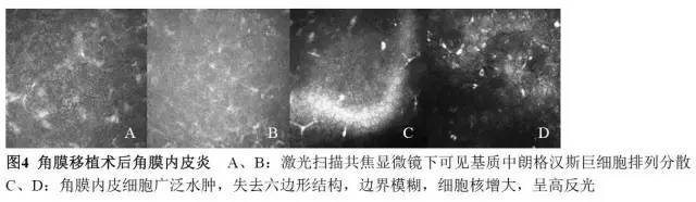 角膜内皮移植排斥反应大吗,角膜内皮移植术后的影响
