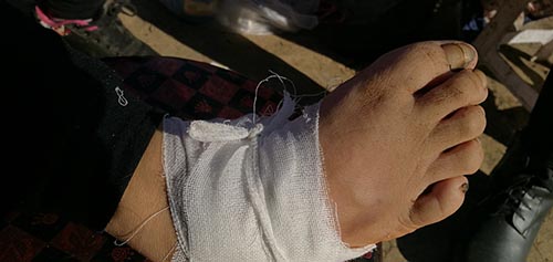 河南一女童遭老鼠咬脚趾,女孩被老鼠咬伤去医院