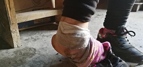 河南一女童遭老鼠咬脚趾,女孩被老鼠咬伤去医院