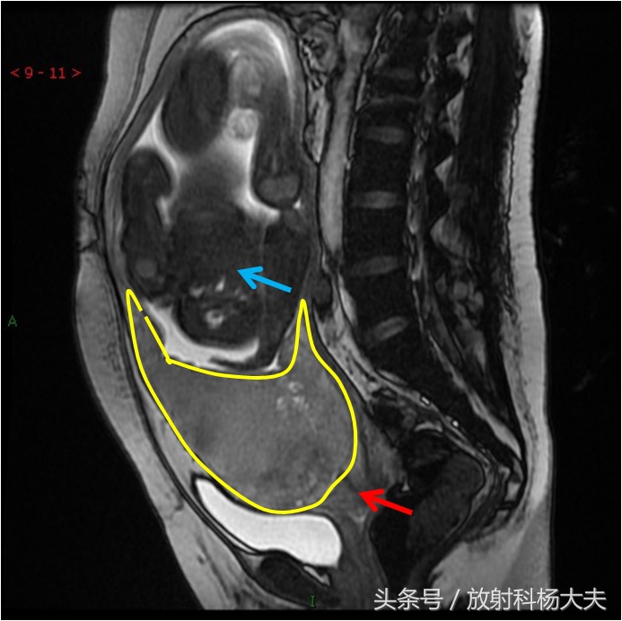 看图!胎盘跑到下面了,就是前置胎盘