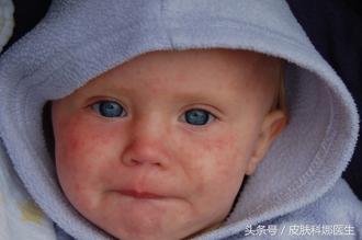 小儿口腔溃疡高烧有哪些偏方,十岁小孩口腔溃疡复发中医辨证