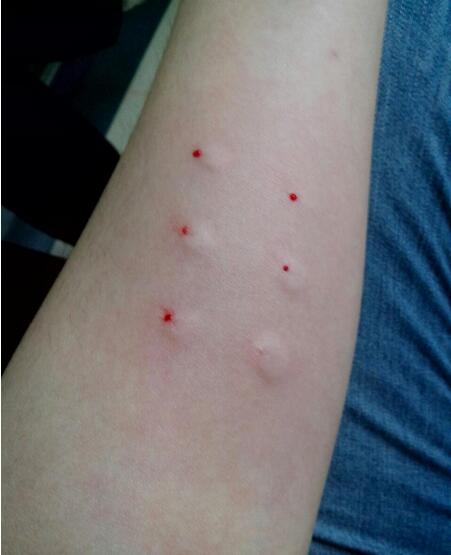 有胎停史再次怀孕有必要查免疫么,胎停免疫治疗多少钱一次