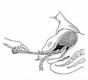 将纱布置于伤口用手按压的止血法,纱布置于伤口按压止血法叫什么