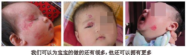 宝宝得了血管瘤妈妈要忌口吗,肝右侧实性结节血管瘤应注意什么