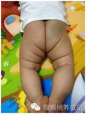 大腿纹不对称图片大全,新生儿大腿皮纹不对称怎么办