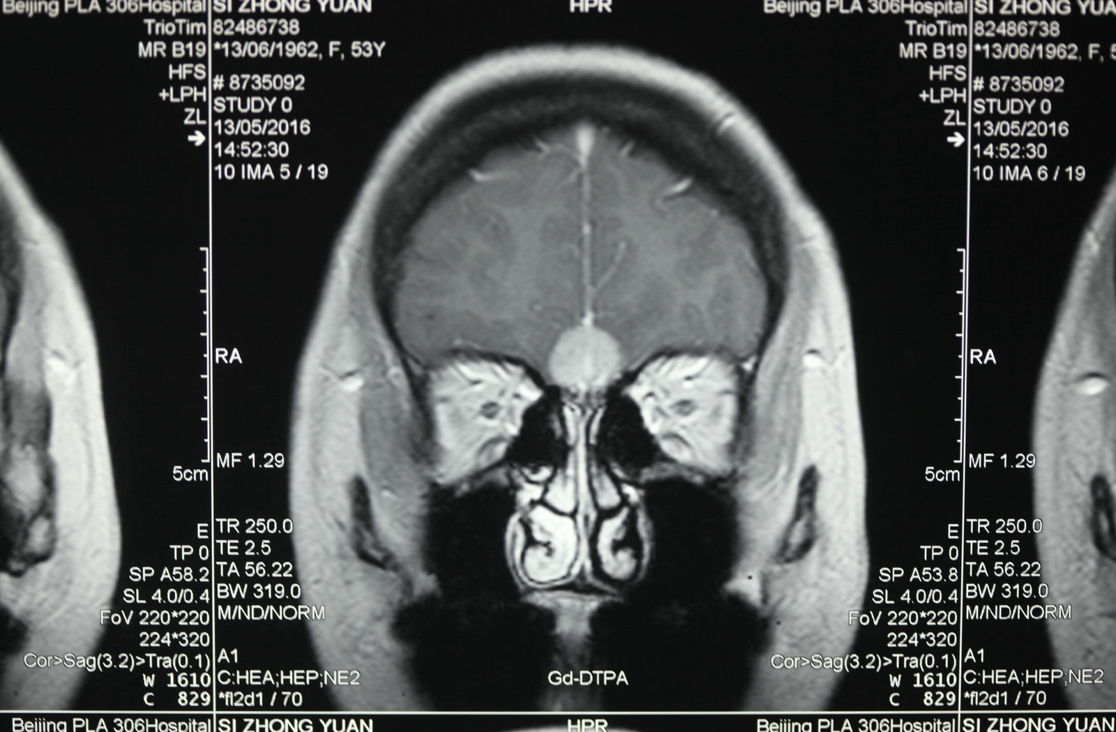 神经外科纪实视频,显微神经外科手术费用