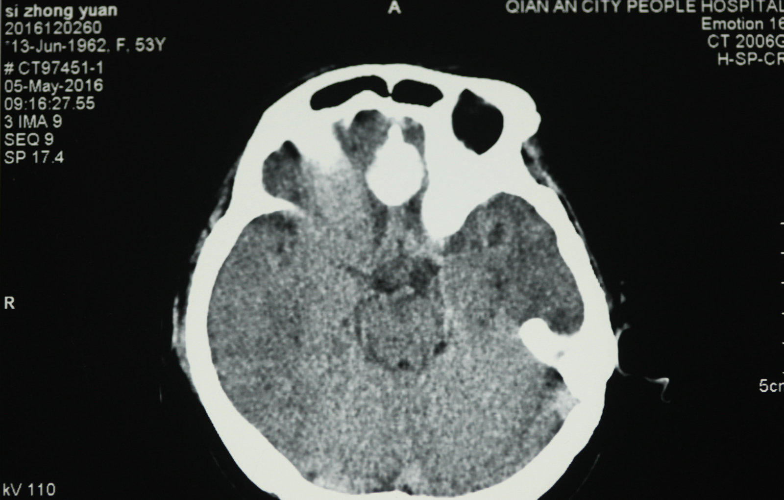 神经外科纪实视频,显微神经外科手术费用