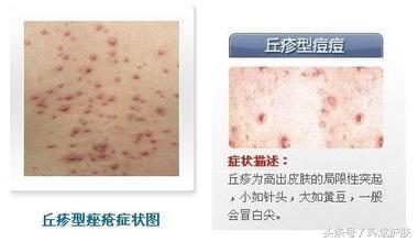 丘疹型痘痘怎么治疗,丘疹型痘痘怎么治疗最彻底