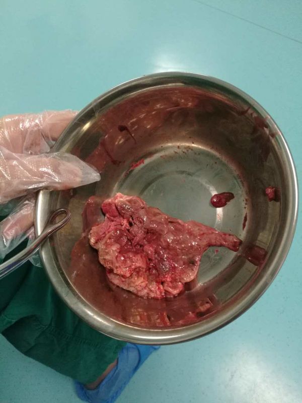 孕13周人流手术有风险吗,前置胎盘疤痕妊娠能撑到37周么