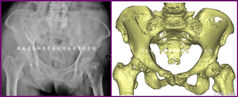 经皮置入术在骨盆髋臼骨折治疗中的应用骨医小灶第二十一期(中)