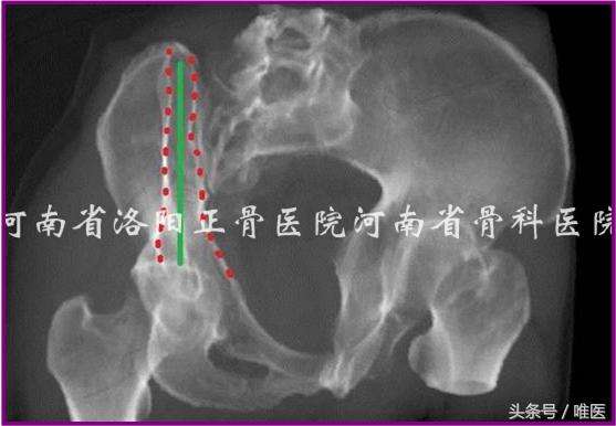 经皮置入术在骨盆髋臼骨折治疗中的应用骨医小灶第二十一期(中)