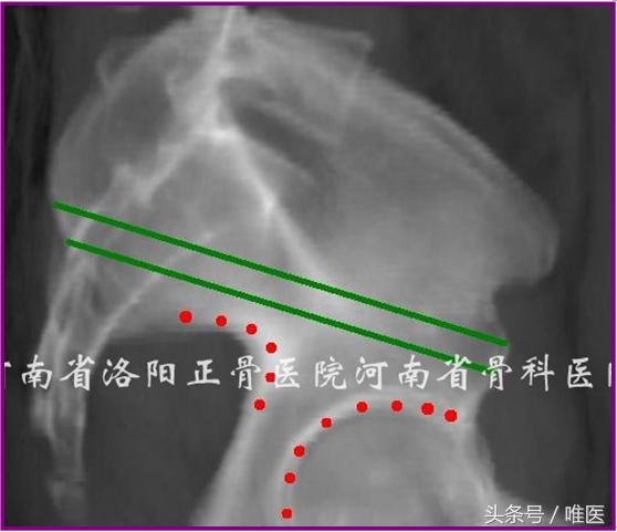 经皮置入术在骨盆髋臼骨折治疗中的应用骨医小灶第二十一期(中)