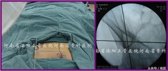 经皮置入术在骨盆髋臼骨折治疗中的应用骨医小灶第二十一期(中)