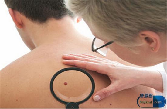 得皮肤癌会有哪些症状？常吃一物预防它