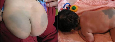 胎记、血管瘤治疗方式很重要！